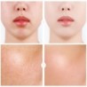 Hyaluronic acid - moisturizing serum - whitening - acne care