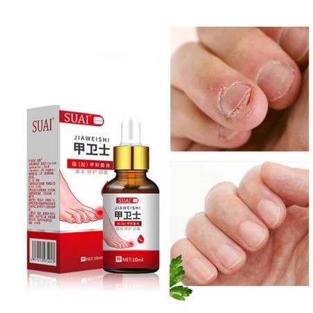 Toenail fungus removal gel - serum - anti infection / paronychia / onychomycosis - 10mlTreatment