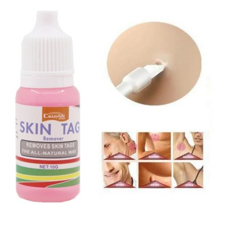 Skin tag removal - foot warts - medical liquid - 10ml - 2 piecesSkin