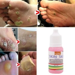 Rimozione dell'etichetta della pelle - verruche del piede - liquido medico - 10 ml - 2 pezzi