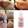 Élimination des acrochordons - verrues des pieds - liquide médical - 10 ml - 2 pièces